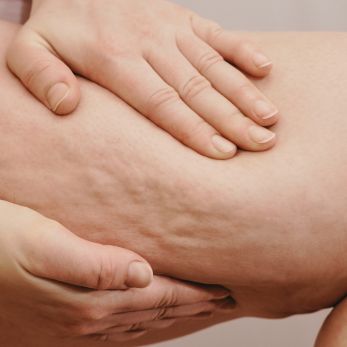 skóra-cellulit-wodny