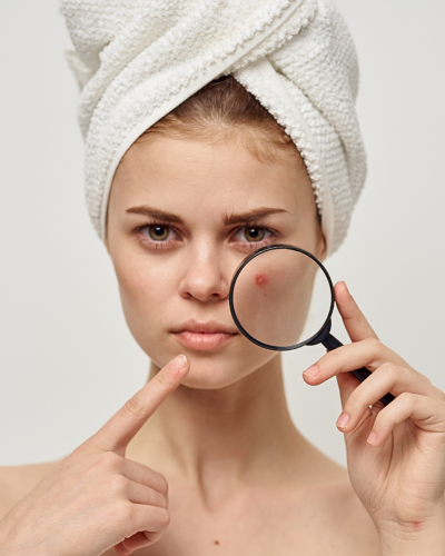 kobieta-lupa-zaskórniki-działanie-kwasu-salicylowego